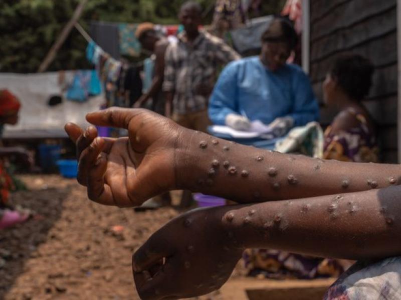 mpox afrique