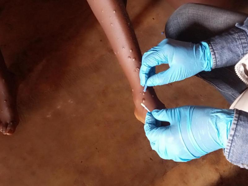 mpox afrique